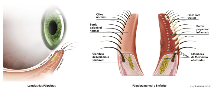 blefarite-sintomas