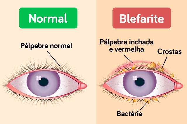 Como Tratar a Blefarite e Aliviar o Desconforto Ocular